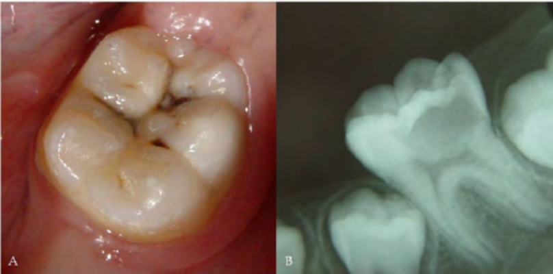 Detection-of-occlusal-caries-A-Clinical-aspect-of-a-lesion-in-an-intact-surface-B.png