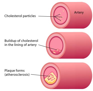 cholesterol_arteries.jpg